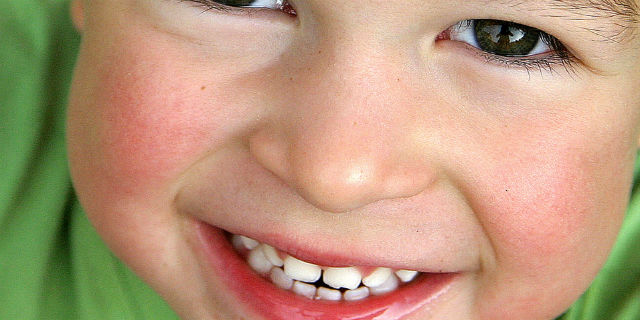 denti da latte storti